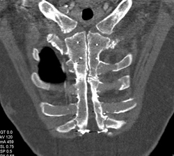 Medial Sternotomy S/P Coronary Artery Bypass Graft (CABG) - CTisus CT Scan