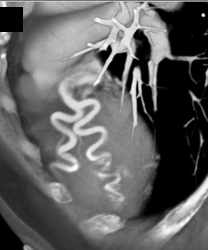 Dilated Coronary Artery in An Er Patient - CTisus CT Scan