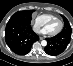 Pericardiac Nodes - CTisus CT Scan