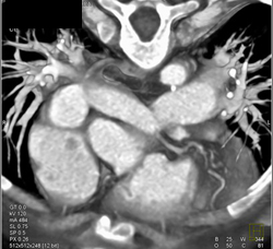 Repaired Tetralogy - CTisus CT Scan