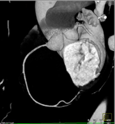 Normal RCA in Many Views - CTisus CT Scan