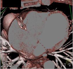 Normal Right Coronary Gives Rise to Posterior Coronary Artery - CTisus CT Scan