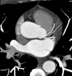 Normal Left Coronary Artery as MIP - CTisus CT Scan