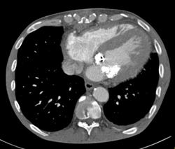 Mitral Annulus Calcification - CTisus CT Scan