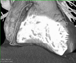 PVC Leads to Step Off Artifact - CTisus CT Scan