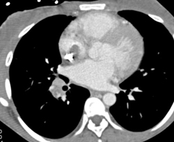 Clot Adjacent to Catheter in SVC - CTisus CT Scan