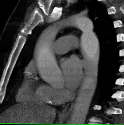 Coarctation of the Aorta - CTisus CT Scan