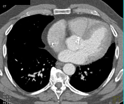 Coarctation of the Aorta - CTisus CT Scan