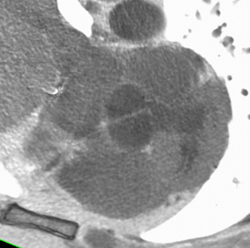 Bicuspid Valve - CTisus CT Scan