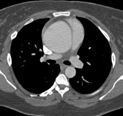 Dilated Aortic Root With Type A Dissection - CTisus CT Scan