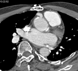 Reimplanted RCA S/P Aortic Root Surgery - CTisus CT Scan