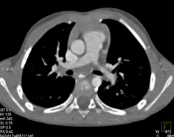 Internal Mammary Arteries as Collateral Pathway - CTisus CT Scan