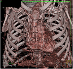 Collaterals Through Internal Mammary and Intercostal Arteries - CTisus CT Scan