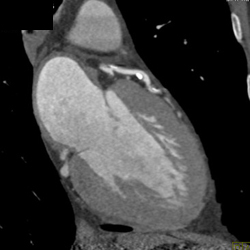 LAD Disease- Greater Than 50% - CTisus CT Scan