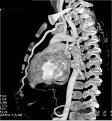 Interrupted Arch With Dilated Internal Mammary Artery - CTisus CT Scan