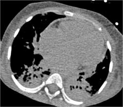 Thickened Pericardium - CTisus CT Scan