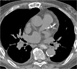 LAD and RCA Disease - CTisus CT Scan