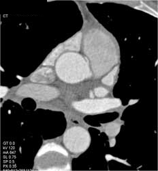 RCA Arises Off Left Cusp and Travels Between Aorta and Pulmonary Outflow Tract - CTisus CT Scan