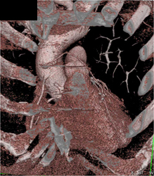 Venous Grafts - CTisus CT Scan