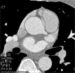 RCA Arises Off Left Cusp - CTisus CT Scan