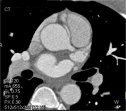 RCA Arises Off Left Cusp - CTisus CT Scan