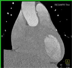 RCA Arises Off Left Cusp - CTisus CT Scan