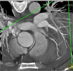 RCA Arises Off Left Cusp - CTisus CT Scan