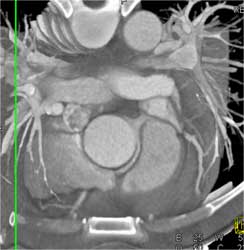 RCA Arises Off Left Cusp - CTisus CT Scan