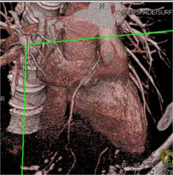 RCA Arises Off Left Cusp - CTisus CT Scan