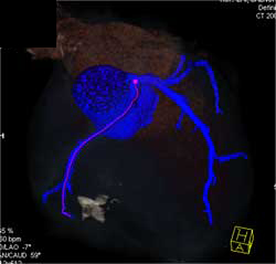 RCA Arises Off Left Cusp - CTisus CT Scan