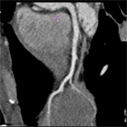 Normal LAD - CTisus CT Scan