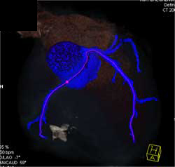 Normal LAD - CTisus CT Scan