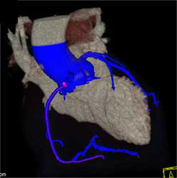 Normal RCA - CTisus CT Scan