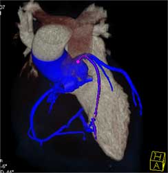 Normal LAD - CTisus CT Scan