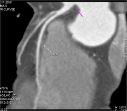 Normal LAD - CTisus CT Scan