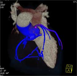 Normal Circumflex - CTisus CT Scan