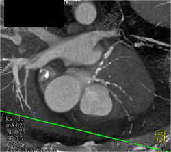 Extensive Calcifications in Left Circulation - CTisus CT Scan