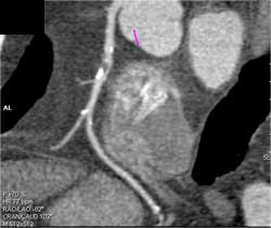 Diseased LAD - CTisus CT Scan