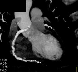 Heavily Calcified Coronary Artery Plaques - CTisus CT Scan