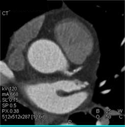 Diseased LAD - CTisus CT Scan