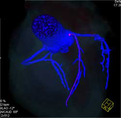 Diseased LAD - CTisus CT Scan