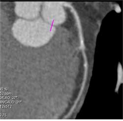 Diseased LAD - CTisus CT Scan