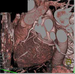 Minimal Plaque LAD - CTisus CT Scan