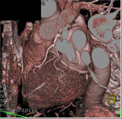 Normal Ramus Intermedius - CTisus CT Scan