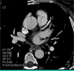 Less Than 50% Stenosis LAD With Calcified and Noncalcified Plaque - CTisus CT Scan