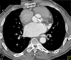 Diseased Aortic Valve With Aortic Stenosis - CTisus CT Scan