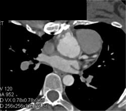 Dilated Coronary Artery at Reimplantation Site - CTisus CT Scan