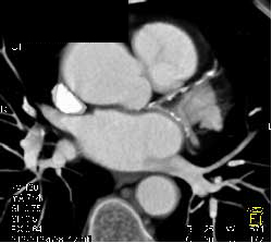 Extensive Calcified Plaque LAD & Circumflex Artery (CX) - CTisus CT Scan