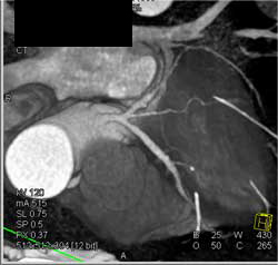 Myocardial Bridging - CTisus CT Scan