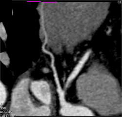 Myocardial Bridging - CTisus CT Scan